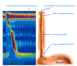 High Resolution Oesophageal Manometry and pH Monitoring ...