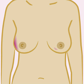 A lump or thickening that feels different from the rest of the breast tissue