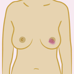 Redness or a rash on the skin and/or around the nipple