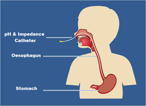 Side image of child showing catheter being inserted