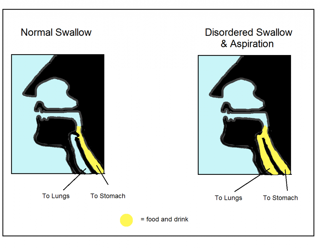 Swallowing difficulties in dementia