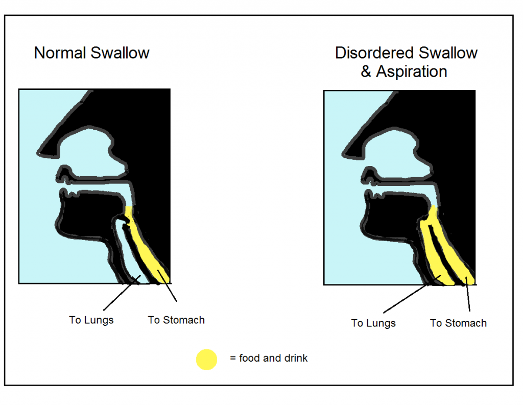 Swallowing Difficulties In Dementia Hull University Teaching 