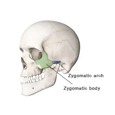 cheekbone fracture treatment nhs