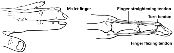 Mallet finger