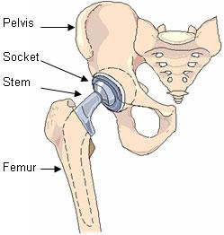 Pelvis, Socket, Stem, Femur