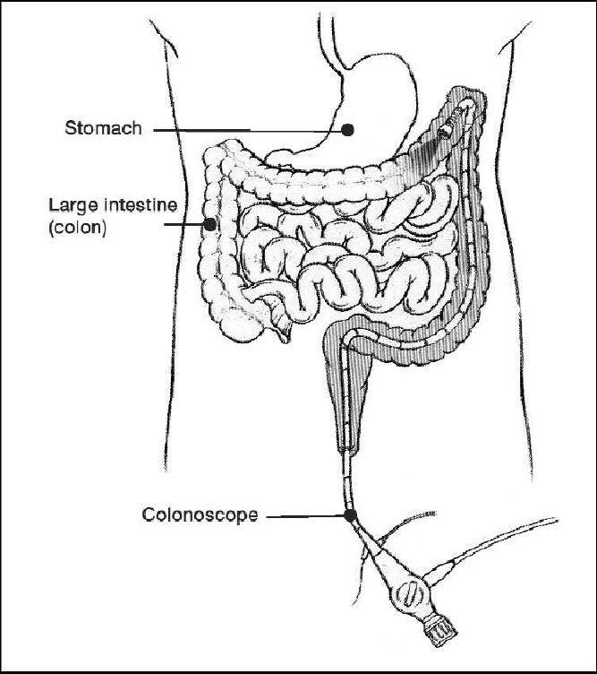 What is a colonoscopy?