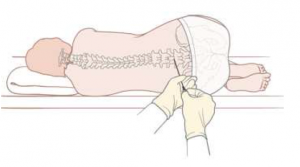 lumbarPuncture