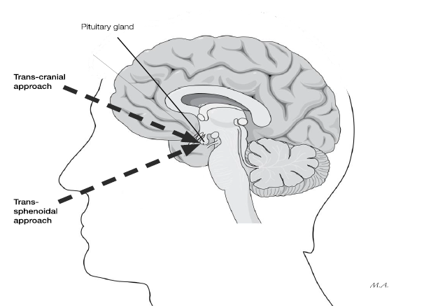 What does pituitary surgery involve