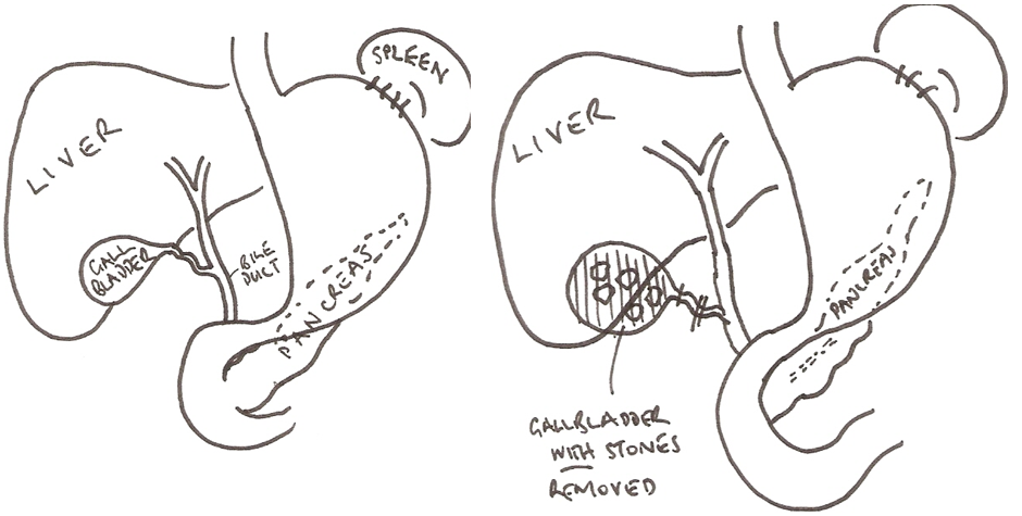 Ultrasound-guided double-tract percutaneous cholecystostomy combined with a  choledochoscope for performing cholecystolithotomies in high-risk surgical  patients | Surgical Endoscopy