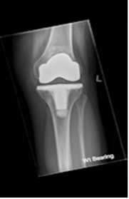 Post-operative X-ray of a knee replacement