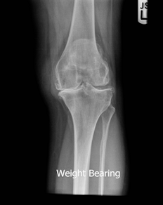 Pre-operative X-ray of an arthritic knee