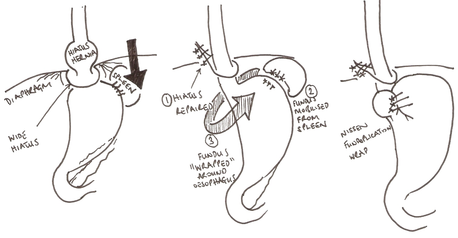 Hiatal Hernia Surgery: Recovery, Scars, and More