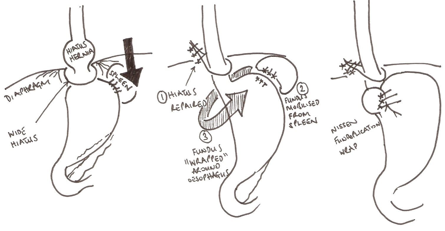 How long is the expected recovery time after hiatal hernia surgery?