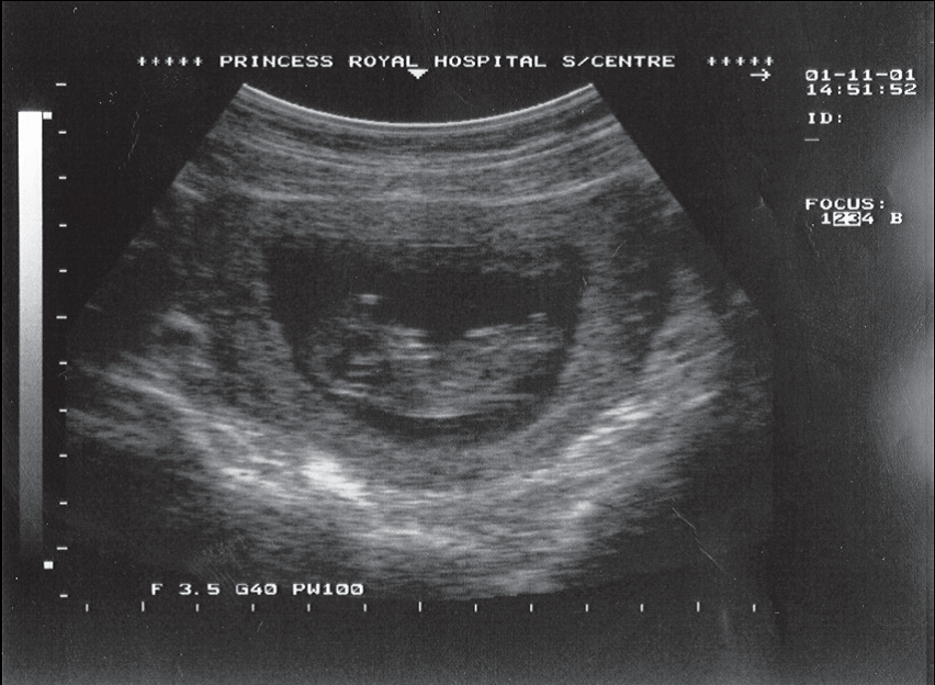 how accurate is the due date on ultrasound