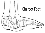 Charcot Foot