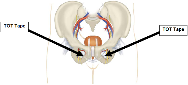 What is urinary stress incontinence