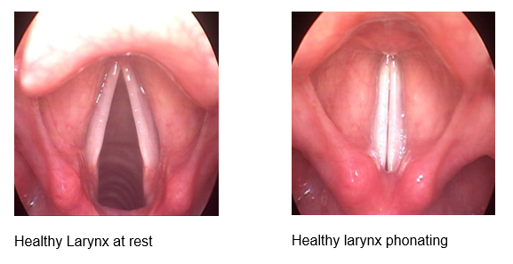 2 photo images. First showing healthy larynx at rest and second showing healthy larynx phonating.
