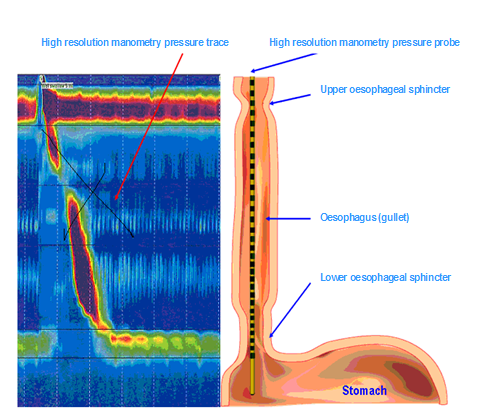 What is high resolution oesophageal manometry