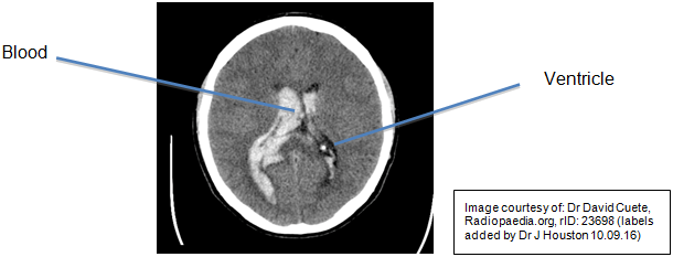 Figure 1 - A brain scan showing IVH