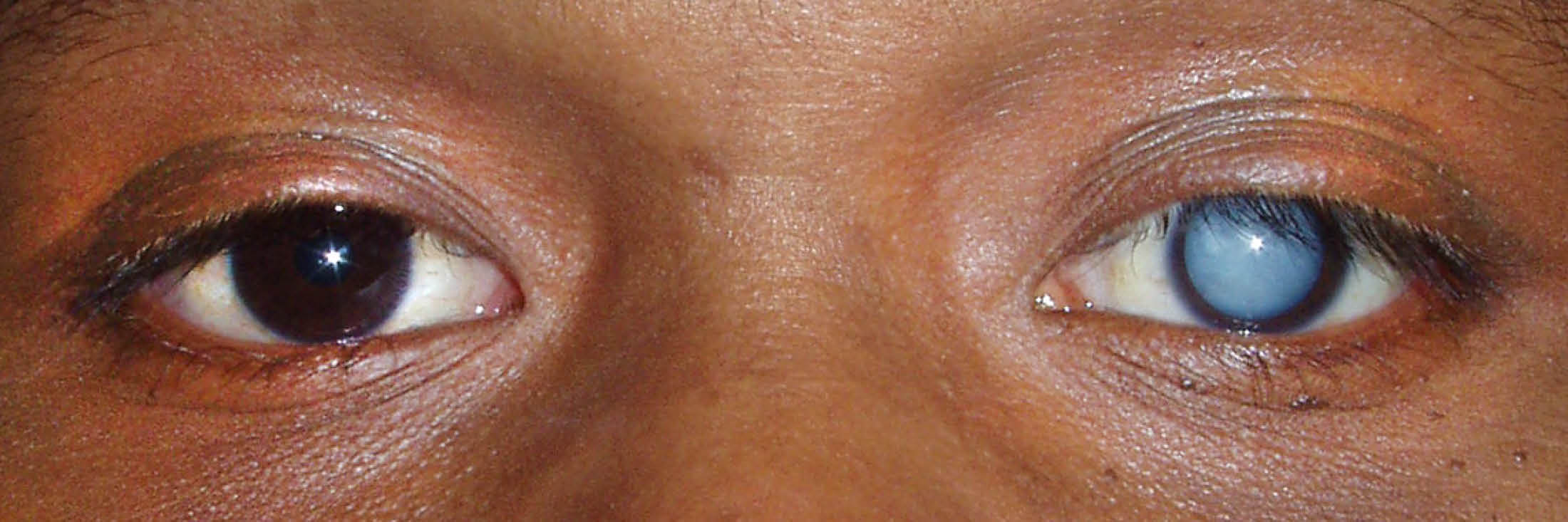 File:Intumescent cataract.jpg - Wikipedia