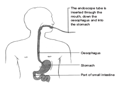 lower endoscopy procedure