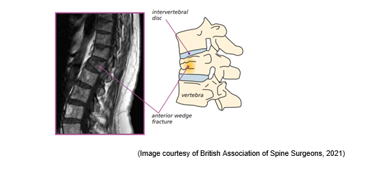 X-ray image and drawing image of a spinal fracture