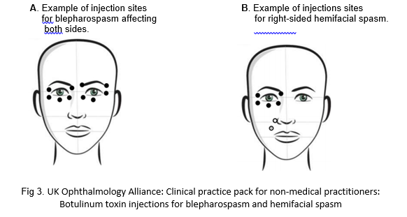 Two images. First shows dots around both eyes indicating injection sites for blepharospasm. Second image shows dots around right eye, indicating injection sites for right sided hemifacial spasm.