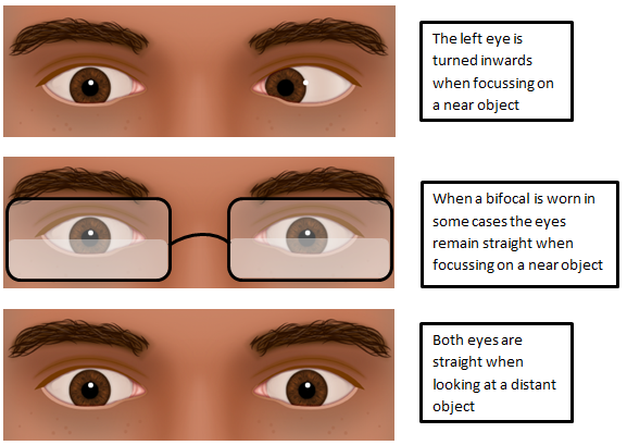 Convergence Excess Type Intermittent Esotropia Hull University Teaching Hospitals Nhs Trust Convergence Excess Type Intermittent Esotropia Hull University Teaching Hospitals Nhs Trust