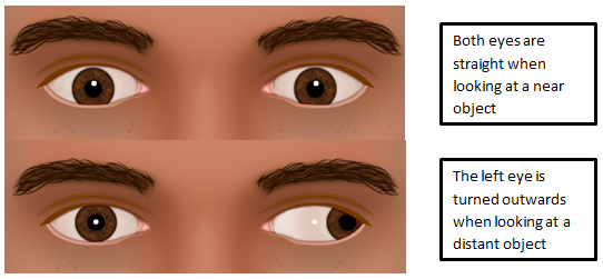 Intermittent Distance Exotropia Hull University Teaching Hospitals Nhs Trust Intermittent Distance Exotropia Hull University Teaching Hospitals Nhs Trust