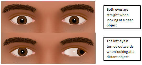 Intermittent Distance Exotropia Hull University Teaching Hospitals Nhs Trust