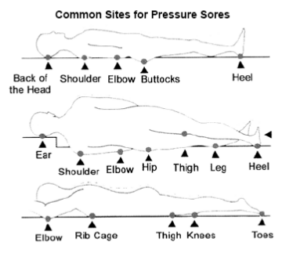 A diagram showing common sites for pressure sores