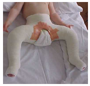 Picture of a child with the Hip Spica cast applied