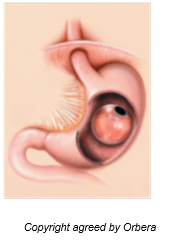 Image of Orbera Intragastric Balloon in place.