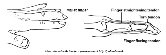 Imaging showing mallet finger