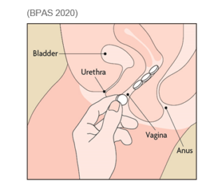 Image showing where to place the tablets in the vagina.