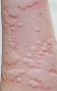Image of person's arm showing raised bumps (urticaria)